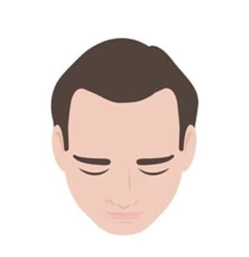 Stage 1