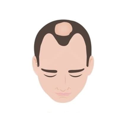 Stage 3