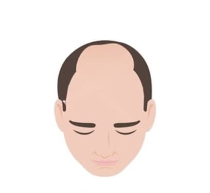 Stage 4
